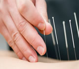 Acupuntura em Sumaré